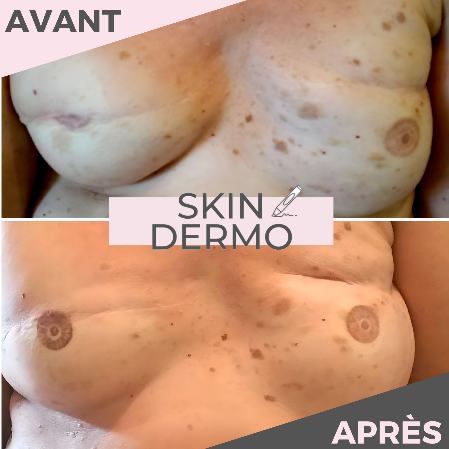 Avant/Après dermopigmentation d'aréoles mammaires après un cancer du sein