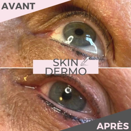 maquillage-permanent-yeux-correction-rate-skin-dermo Photo avant/après d'une correction de raté d'un maquillage permanent des yeux