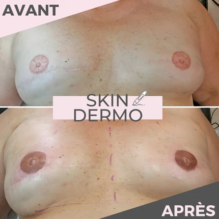Avant/Après d'une dermopigmentation réparatrice d'aréoles mammaires après un cancer du sein