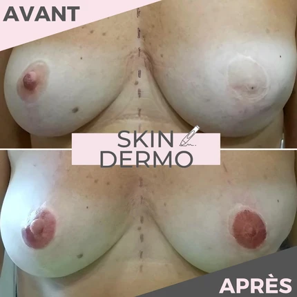 Avant/Après dermopigmentation d'aréoles mammaires après une chirurgie.