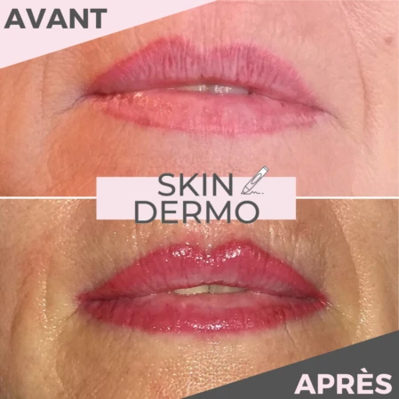 maquillage-permanent-levres-correction-rate-skin-dermo Photo avant/après d'une correction d'un ancienmaquillage permanent des lèvres raté