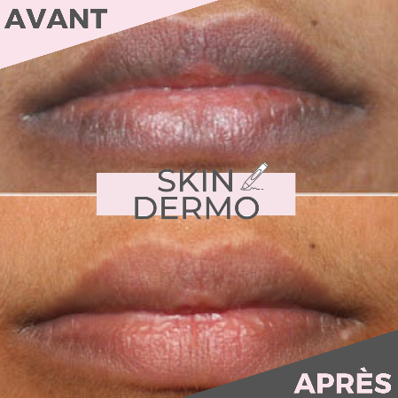Photo avant/après d'un maquillage permanent des lèvres pour éclaircir les lèvres hyperpigmentées