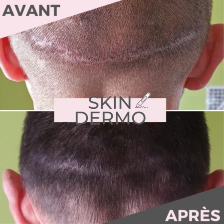 tricopigmentation-camouflage-cicatrice-cheveux-skin-dermo Photo avant/après d'une tricopigmentation capillaire pour camoufler une cicatrice